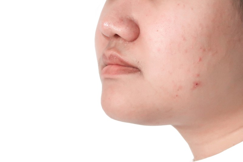 Pickel und Hautausschlag sind Krankheitssymptome, die man vom Gesicht ablesen kann