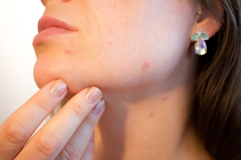 Man sieht eine Frau mit Pickel und es geht um Beauty Tipps für den Sommer.