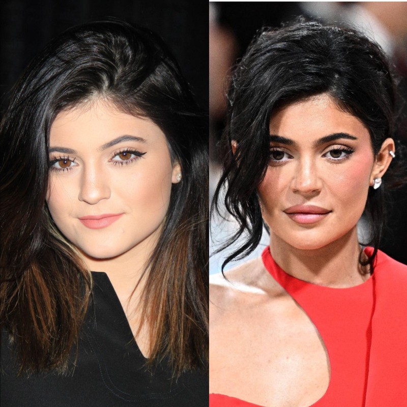 Kylie Jenner hat jahrelang zu ihren Operationen geschwiegen – mittlerweile steht sie dazu.