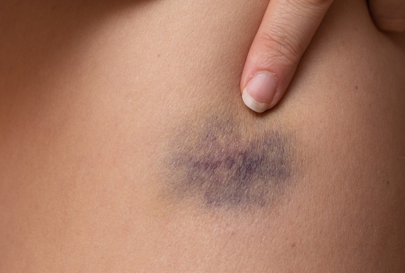 Blaue Flecken gehören zu den häufigsten Verletzungen, die du während des Liebesspiels davontragen kannst.
